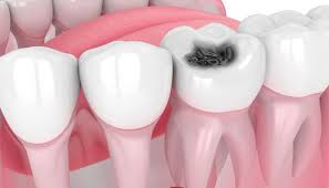 Cavity Causes