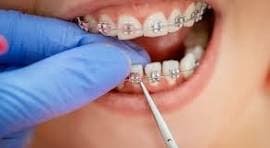 Orthodontics Benefits