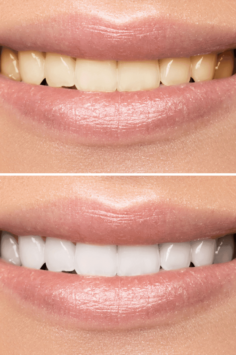 whitening